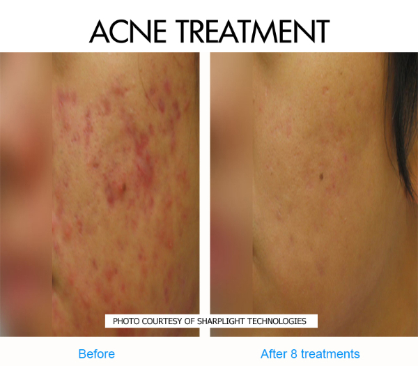 acne-1-before-and-after-picture