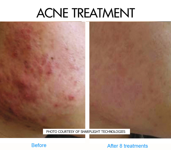 acne-2-before-and-after-picture