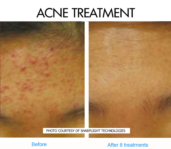 acne-3-before-and-after-picture
