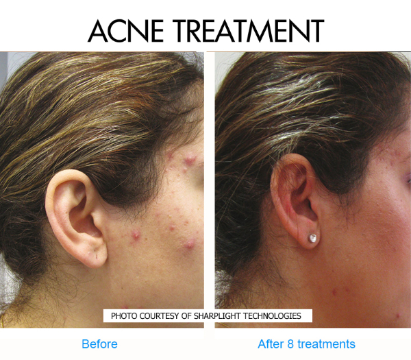 acne-type-2